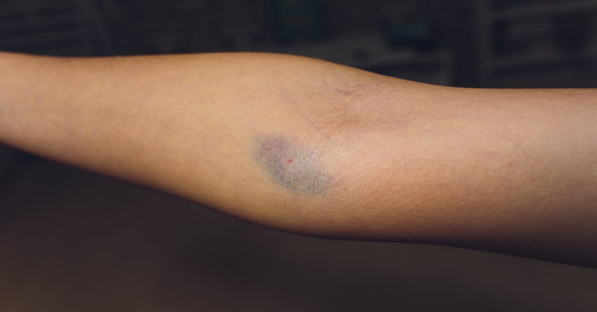How to Get Rid of Bruises from Intravenous Drug Use?